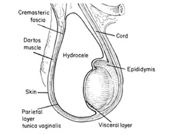 Hydrocele