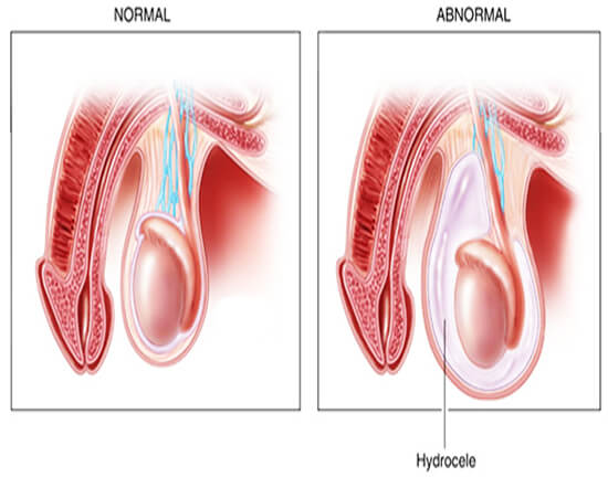 Hydrocele